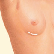 breast enlargment cyprus.png